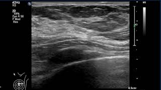 mortons neuroma bursal complex [upl. by Sirahc]