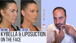 What You Need to Know About Liposuction amp Kybella in the Face [upl. by Annabell]