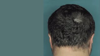 Causes and Treatment of Hair Loss  Alopecia Areata [upl. by Rhodes]