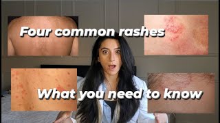 Four common rashes and everything you need to know about them [upl. by Huda136]