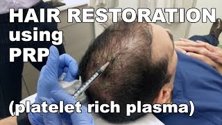 Scalp Hair Restoration using Platelet Rich Plasma  West End Plastic Surgery [upl. by Zurheide]