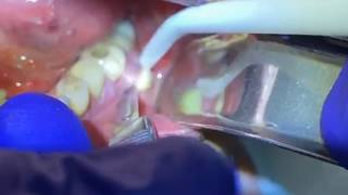 Draining a Dental Abscess  Advanced Dental Care [upl. by Manchester]