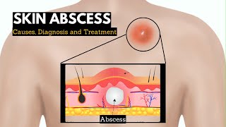 Skin Abscess Causes Signs and Symptoms Diagnosis and Treatment [upl. by Frey]