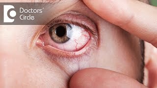 What causes visible red fine lines in eyes  Dr Elankumaran P [upl. by Bendix]