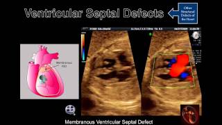 Fetal Echocardiography Ventricular Septal Defects [upl. by Shaylyn]