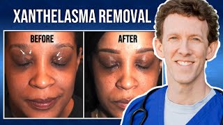 Removing Xanthelasma with Lasers  Thirzas Testimonial [upl. by Sokil]