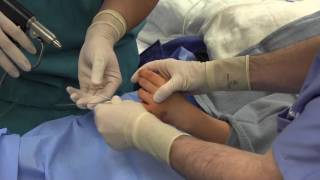 Phalangeal Neck Fracture Percutaneous Strauch Pinning [upl. by Grannia]