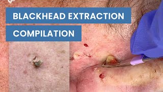 Extraction Satisfaction Blackhead Removal  CONTOUR DERMATOLOGY [upl. by Dalis489]