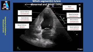 Wall Motion Abnormality Part II cases amp practice [upl. by Nolahs485]