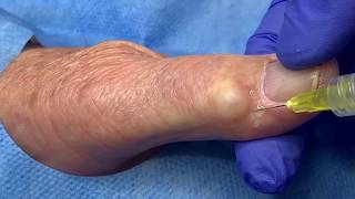 Ganglion Cyst Jelly Doughnut Hole Extraction [upl. by Doloritas]