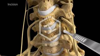 c5c6c7 Anterior Cervical Discectomy with Fusion [upl. by Guido577]