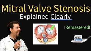 Mitral Valve Stenosis Diagnosis Treatment Pathophysiology [upl. by Elga]