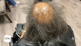 Covering bald spot  scarring alopecia [upl. by Akimet]