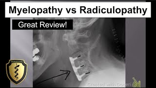 Symptoms of Cervical Stenosis  Jeffrey Cantor MD [upl. by Ferwerda]