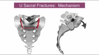 Sacral fractures  classifications and indications [upl. by Erastatus375]