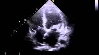 Echocardiography to Assess MitralValve Leaflets  NEJM [upl. by Onej]