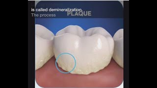 Stage 1 of Tooth Decay Demineralization [upl. by Ytsirc]