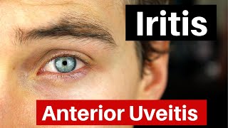 Iritis  What is Anterior Uveitis Doctor Explains [upl. by Lorilyn781]