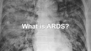 Developing New Treatments for ARDS A Devastating Condition [upl. by Ilek799]