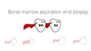 Bone Marrow Biopsy amp Aspiration BMBx [upl. by Julide]