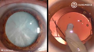 How to Prevent Cataracts With Natural Remedies – Dr Berg [upl. by Casady]