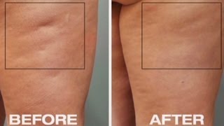 New tool to fight cellulite [upl. by Notnef309]