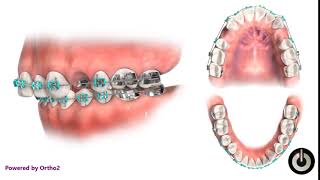 Upper First Premolar Extraction  Dental Braces  Temecula Valley CA [upl. by Maurizia]