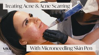 This Is Microneedling for Acne Scarring 🎯 [upl. by Dranyar186]