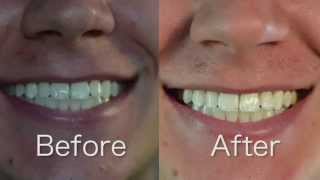 Crest 3D White Whitestrips 1 Hr Express Review and BeforeAfter [upl. by Idnac337]