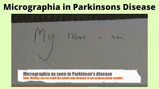 Micrographia in Parkisons disease [upl. by Enimsay]