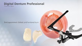 Digital Denture – third Appointment [upl. by Cud204]