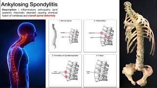 Ankylosing Spondylitis  Mechanism Risk Factors amp SignsSymptoms [upl. by Corey83]