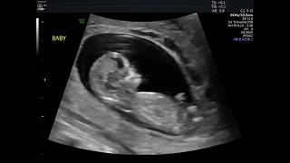 12 WEEK ULTRASOUND MY BABY MOVING amp HEARTBEAT [upl. by Linc]