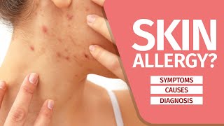 What is Skin Allergy Symptoms Causes Diagnosis and Triggers [upl. by Sirtaeb78]