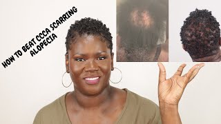 5 things that really work for CCCA or scarring alopecia [upl. by Marsh]