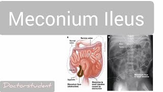 Meconium Ileus [upl. by Hamitaf]