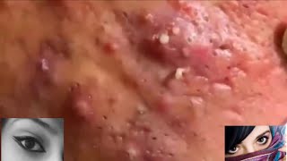 Severe Cystic Acne Infection Treatment Young Age [upl. by Okim]