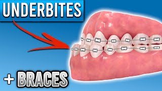 How Do Braces Fix Underbites  Premier Orthodontics [upl. by Templer]