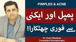 How To Remove Pimples Overnight  Acne Treatment  Pimple Khatam Karne Ka Tarika [upl. by Siednarb46]