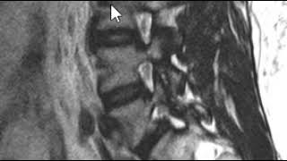 Lumbar Spine MRI  Pars Defect [upl. by Raf478]