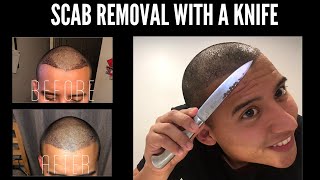 Hair Transplant scab removal DAY 8 Postop [upl. by Dnalhsa]