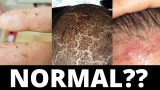 These 3 Things Are Normal After A Hair Transplant [upl. by Ocer189]