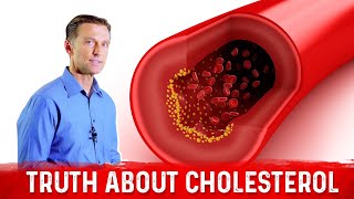 The Truth About Cholesterol – LDL Cholesterol amp HDL Cholesterol – DrBerg [upl. by Ylirama]