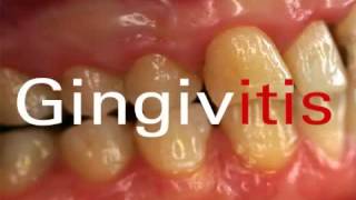 why bleeding gums  what is Gingivitis [upl. by Bein75]