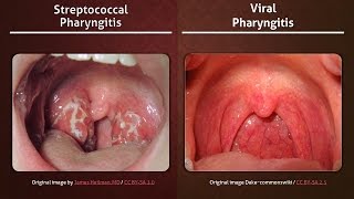 Streptococcal vs Viral Pharyngitis [upl. by Seana]