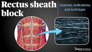 Rectus Sheath Block [upl. by Zaccaria]