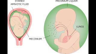 Meconium Aspiration Syndrome and HIE [upl. by Shippee367]