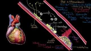 Khan Academy  Atherosclerosis in Heart Disease [upl. by Georgiana]