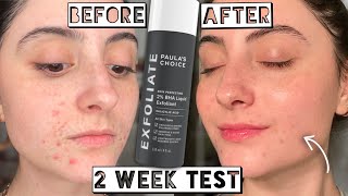 Testing Paula’s Choice 2 BHA LIQUID EXFOLIANT for Acne amp Scarring for 2 weeks [upl. by Gotthelf]