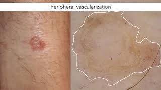 Dermoscopic features of porokeratosis  Dr John Paoli [upl. by Solrac]